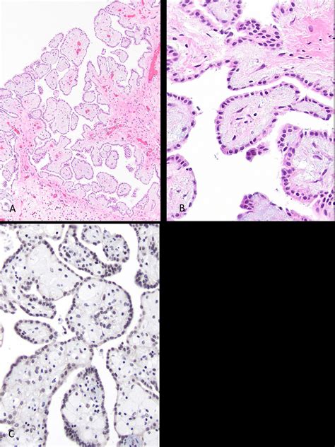 Well Differentiated Papillary Mesothelial Tumor A New Name And New
