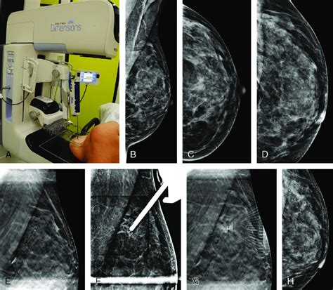 Digital Breast Tomosynthesis Guided Biopsy A Year Old Patient With Download Scientific