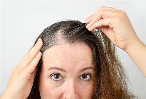 Top 48 Image Womens Hair Loss Vn