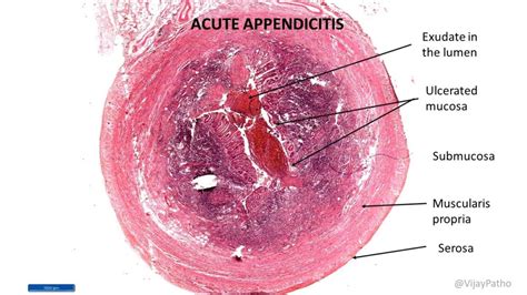 Acute Appendicitis Pathology Made Simple