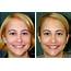 Smile Makeover Images Of Our London Patients