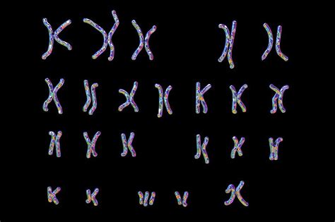 Down S Syndrome Karyotype Photograph By Kateryna Kon Science Photo Library
