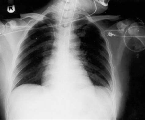 Chest X Ray Of Patient 5 48 H Later Download Scientific Diagram