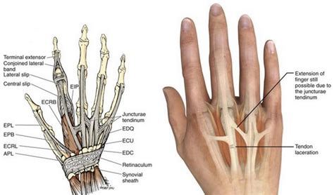 If one or more of the tendons have been damaged, such as being cut for example, they can be repaired surgically. Extensor Tendon Injury Hand Therapy