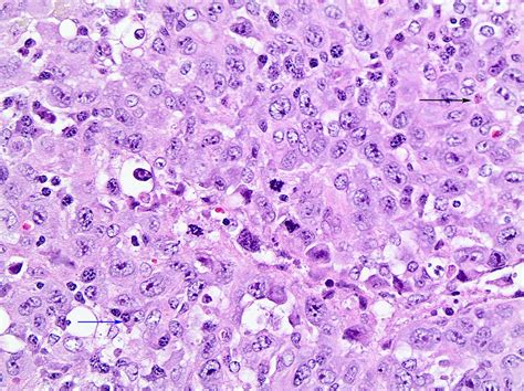 Pathology Outlines Anaplastic Large Cell Lymphoma Alk Positive