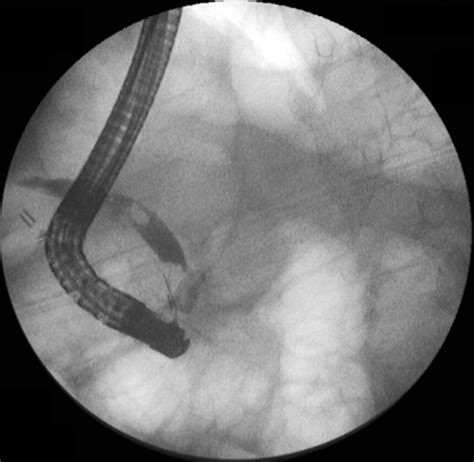 Laparoscopic Cholecystectomy Postoperative Imaging Ajr