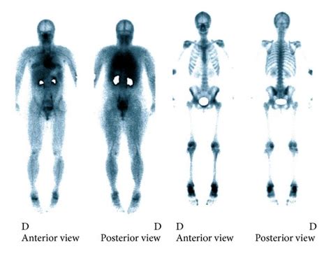 Bone Scintigraphy Performed Two Months After Partum Excessive Uptake
