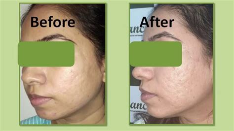Review For Scar Subcision Fat Grafting Acne Scar Surgery Treatment By