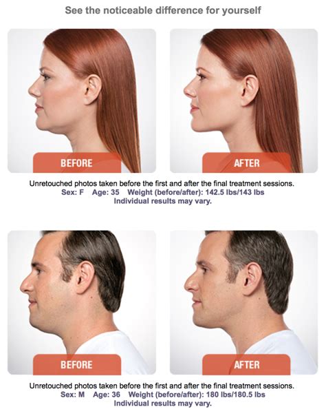 Sculpt And Countour The Jawline With Kybella Kybella Fat Reduction