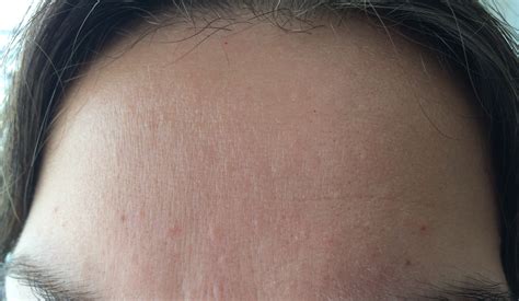 Small Flesh Colored Bumps On Forehead And Hairline Adult Acne Forum