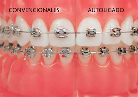 Tipos De Brackets Clínica Dental Fabián López