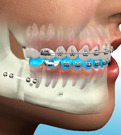Process laser technology represents a change in the fundamental surgical process. Surgical Orthodontics Procedure Hyderabad | Alux Dental