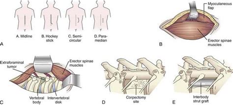 Anterior Thoracic Instrumentation Neupsy Key