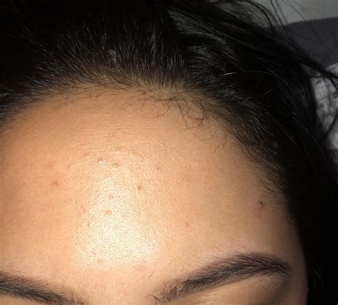 Skin Concern Can Anyone Tell Me What The Bumps In My Forehead Is And