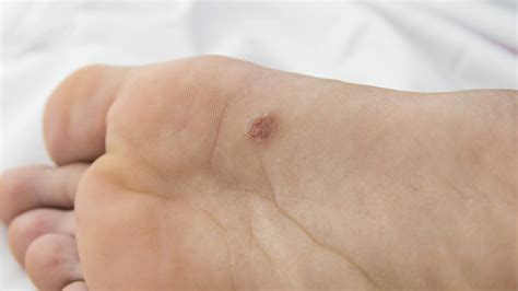 Plantar Wart Stages Of Healing A Comprehensive Guide Myhealthgeek