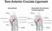 Common Knee Ligament Problems | Buxton Osteopathy Clinic