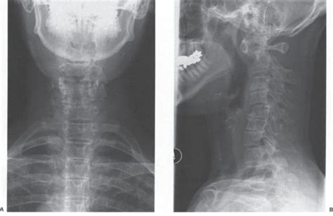 Subaxial Subluxation Of The Rheumatoid Cervical Spine Neupsy Key