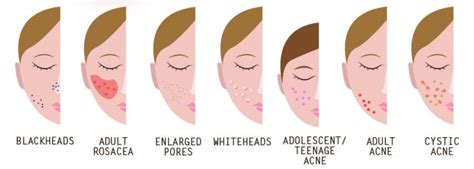 Acne Break Outs Causes Symptoms And Treatments Infographic