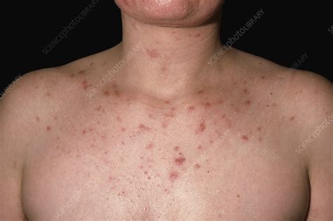 Acne On The Chest Stock Image C048 2927 Science Photo Library