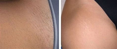 The total cost of laser hair removal is also determined by the number of treatments necessary. How much does laser hair removal cost? - Quora