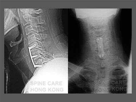 Lower Cervical Spine Fractures And Dislocations