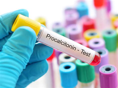 Procalcitonin Sinnvoller Test Zur Diagnose Von Schweren Entzündungen