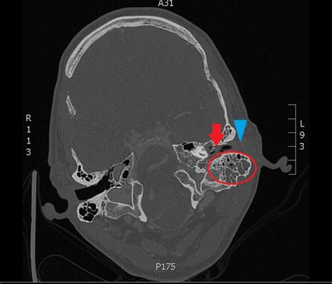 A Case Of Otomastoiditis Jetem