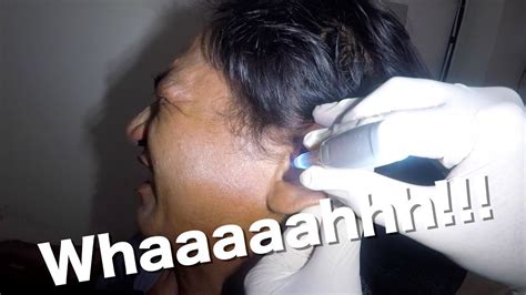 Mans Hard Clogged Earwax Finally Removed By Ear Suctioning Youtube