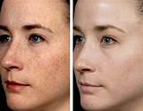 Pictures of Laser Treatment To Remove Scars On Face
