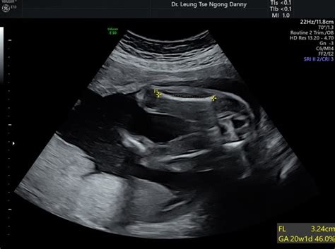 Fetal Biometry Hkog Info