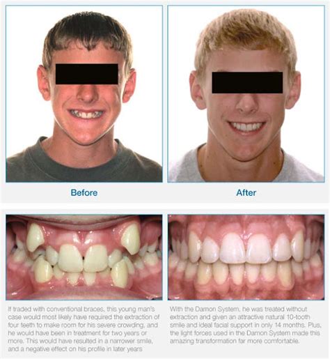 Quick Accelerated Braces Treatment With DAMON SYSTEM