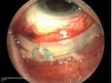 Images of Scleral Buckle Surgery Recovery