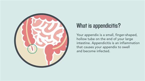 Appendicitis Symptoms Causes Diagnosis And Treatment Merck Manual