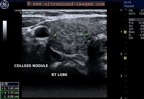 Ultrasound Imaging Multiple Colloid Nodules Thyroid
