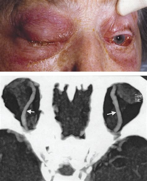 Cavernous Sinus Thrombosis The Lancet