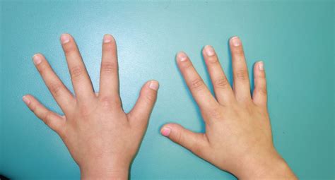 Congenital Hand And Arm Differences September 2013
