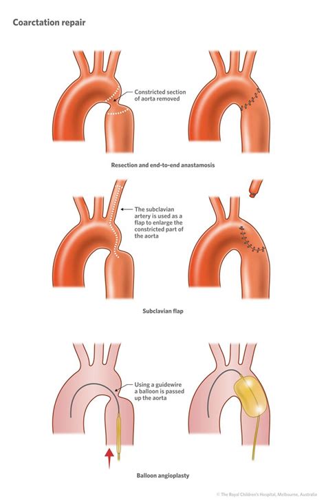 5bcoarctationoftheaorta Coarctation Of The Aorta Pediatric