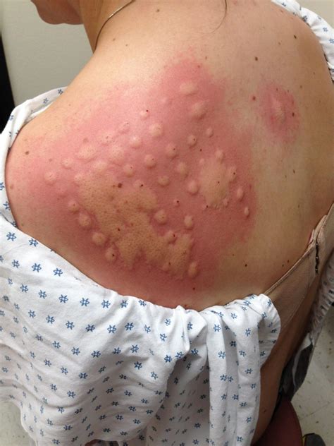 So My Sister Got Her Allergy Test Done And She Was Allergic To