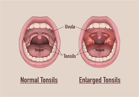 Asumati Un Risc Acuzare Temeritate Before And After Tonsil Removal Trandafir Adaptabilitate Atractiv