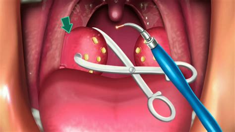 Animation Surgery Of Tonsillectomy And Adenoids Youtube