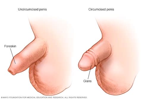 Circumcision Male Beacon Health System