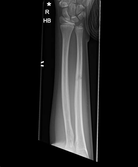 Midshaft Radius And Ulna Fractures Dont Forget The Bubbles