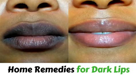 How To Get Rid Of Black Lips Home Remedies For Dark Lips Youtube