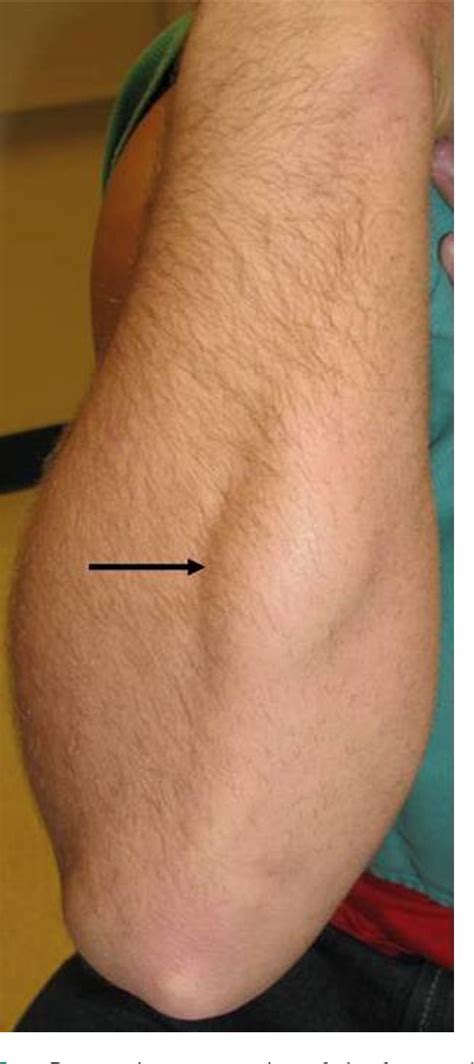 Figure 1 From Repair Of Symptomatic Forearm Hernias Using Acellular