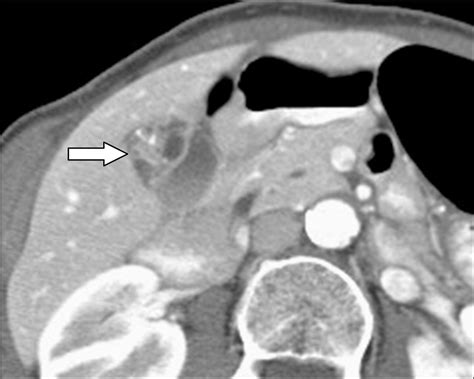 Uncommon Intraluminal Tumors Of The Gallbladder And Biliary Tract