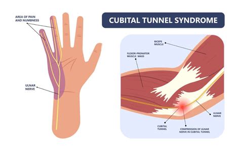Cubital Tunnel Syndrome Joint Rehab And Sports Medical Center