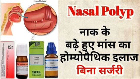 Nasal Polyps Homeopathic Medicine For Nasal Polyps Treatment Without