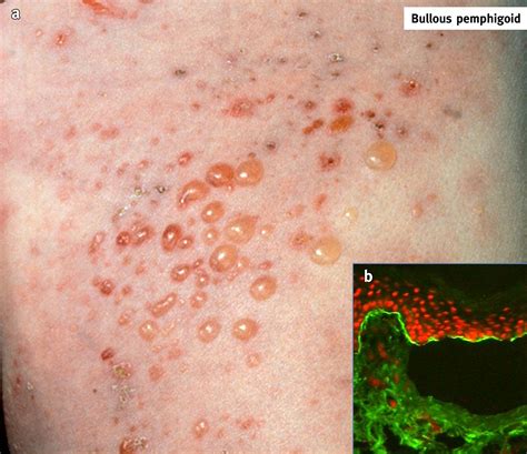 Autoimmune Blistering Skin Diseases Medicine