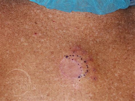 Melanoma Archives Skin Cancer And Reconstructive Surgery Center