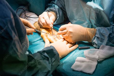 Hand Surgery Stock Image C0349748 Science Photo Library